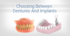 Choosing-Between-Dentures-And-Implants