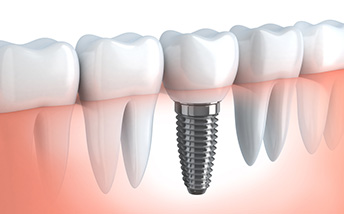 Implant Denture Procedure